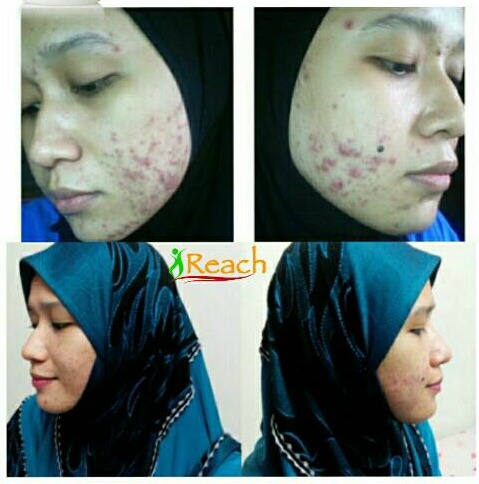 Hp redmi terbaru rilis, segini harga redmi note 11 4g; Cara Memutihkan Muka Dalam Masa 1 Hari / Metode bleaching